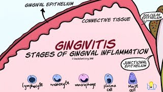 Gingivitis Stages of Gingival Inflammation [upl. by Portia]