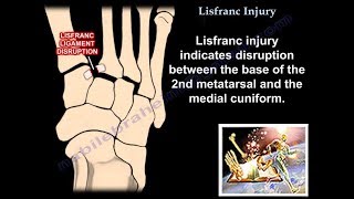 Lisfranc Injury  Everything You Need To Know  Dr Nabil Ebraheim [upl. by Doomham705]