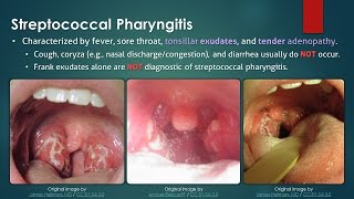 Streptococcal Pharyngitis [upl. by Xonk236]