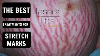 how to treat stretch marks [upl. by Notnek]