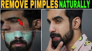 How to Remove PIMPLE NATURALLY FAST REALITY  Acne treatment TheFormalEdit  Hindi [upl. by Annairol]