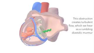 Mitral Stenosis  sound amp animation [upl. by Lefty259]