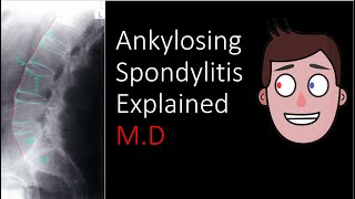 Ankylosing Spondylitis Explained [upl. by Calendre949]