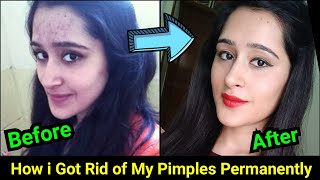 How to Remove Pimples Acne Pimple Marks completely  ThatGlamGirl [upl. by Artap228]