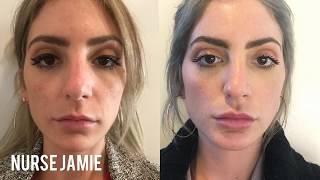 Before and After Micro Needling  Nurse Jamie [upl. by Anneiv768]