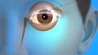 What to Expect After CATARACT SURGERY [upl. by Aniral948]