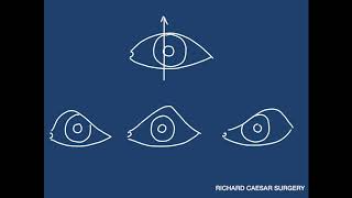 Ptosis Tutorial  A Practical Approach [upl. by Ziul651]