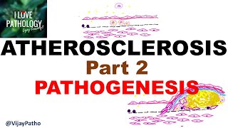 ATHEROSCLEROSIS  Part 2 Pathogenesis [upl. by Ssac243]