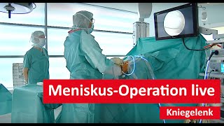 Kniegelenk MeniskusOperation live [upl. by Atteloc]