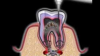 Wurzelbehandlung beim Zahnarzt [upl. by Artenek]