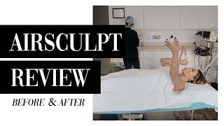 5Month Airsculpt Review  Before amp After [upl. by Lowry]