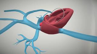 ProtekDuo® Cannula Support Animation [upl. by Norab]