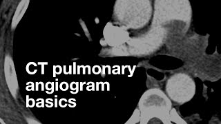 Pulmonary CT Angiogram Basics [upl. by Stannfield]