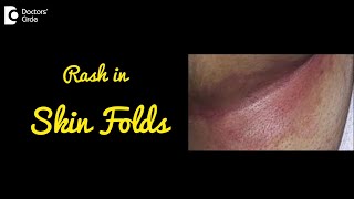 INTERTRIGO  Rash in Skin Folds  Causes Symptoms and Treatment  DrNischal K C  Doctors Circle [upl. by Annert]