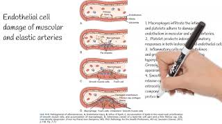 Atherosclerosis  Causes Pathogenesis Prevention [upl. by Drexler731]