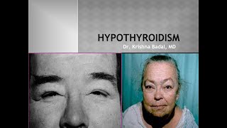 Hypothyroidism Myxedema [upl. by Ann-Marie]