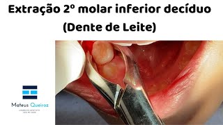 Extração 2º molar decíduo Dente de Leite [upl. by Monahan]