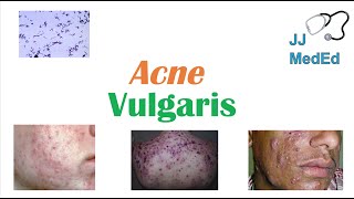 Acne Vulgaris  Causes Pathogenesis Influencing Factors Diagnosis Treatment and Complications [upl. by Tigges]