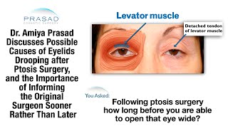 What is Ptosis and How Can It Be Treated [upl. by Joy914]