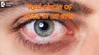 How do I get rid of the orangered circle of veins in my eye  Dr Sriram Ramalingam [upl. by Satterlee]