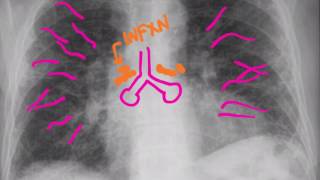 CXR Pneumonias [upl. by Ardnahc]