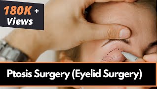 What Happens During Ptosis Surgery as Performed by Oculoplastic Surgeon Dr Amiya Prasad [upl. by Amsirp]