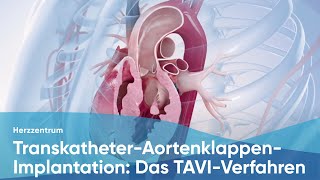 Placing a Transvenous Pacemaker [upl. by Ramoj]