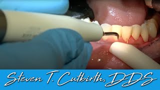 Scaling amp Root Planing  Dental Minute with Steven T Cutbirth DDS [upl. by Rowney529]