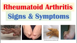 Rheumatoid Arthritis RA Signs amp Symptoms amp Associated Complications [upl. by Hoes]