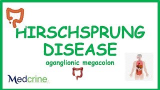 Hirchsprungs Disease Aganglionic Megacolon [upl. by Nemaj232]