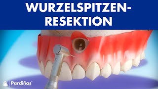 Wurzelspitzenresektion © [upl. by Akedijn327]