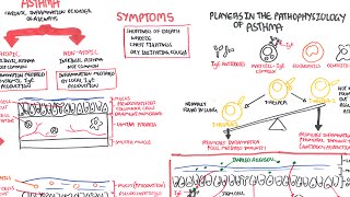 Asthma  signs and symptoms pathophysiology [upl. by Mathilda]