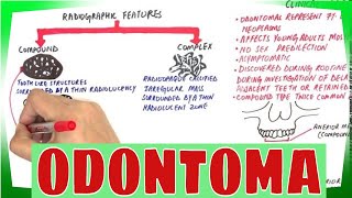 Odontoma  Types Clinical features Histopathological Features amp Treatment [upl. by Ayhdiv640]