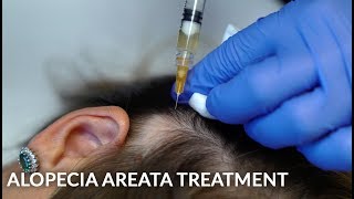 PRP Stem Cells amp Steroid Injections for Alopecia Areata Female Hair Loss Treatment  Dr Jason Emer [upl. by Goldstein63]