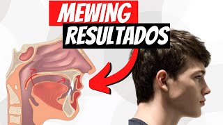 MEWING Resultados  ¿CUÁNTO TARDA [upl. by Annohsal655]