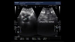 STOMACH PAIN Lunas at Sanhi  ni Dr Willie Ong 163b [upl. by Ethban]