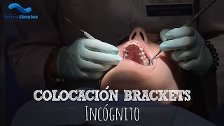 Colocación de brackets linguales Incognito [upl. by Bodnar960]