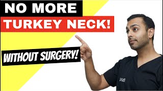 The NONSURGICAL turkey neck lift [upl. by Traggat655]