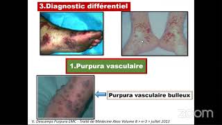 🔴Hématologie Pathologies de lhémostase [upl. by Maurey]