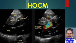 HOCM  Hypertrophic Obstructive Cardiomyopathy [upl. by Nede]