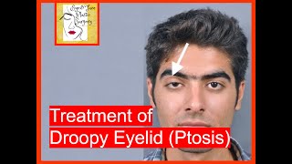 Droopy Eyelid ptosis Treatment and Surgery [upl. by Gilmore981]