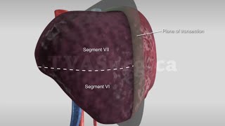 Segment VIVII resection [upl. by Tillio]