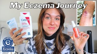 HOW I BEAT MY ECZEMA FOR GOOD  My journey product recommendations  body care tips  Rudi Berry [upl. by Meijer]