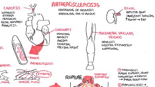 Atherosclerosis  Pathophysiology [upl. by Furr193]