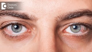 Causes of Red eye  Dr Mala Suresh [upl. by Eimia]