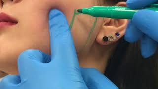 Let’s Talk Botox Masseter Muscle and Jaw Slimming TMJ  6 Month Update [upl. by Gonzalez778]