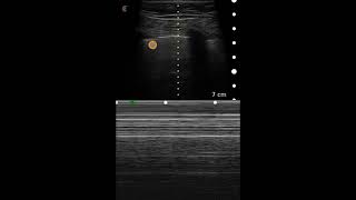 Pneumothorax Ultrasound Image Interpretation [upl. by Zetrac438]