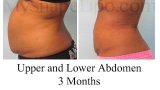 Do I Need Liposuction or Tummy tuck MyShape Lipos Trevor Schmidt PAC Reviews [upl. by Wolbrom]