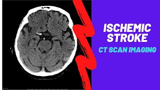 Stroke Endovascular management of ischaemic stroke  radiology video tutorial [upl. by Hanae516]