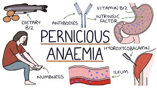 Understanding Pernicious Anaemia B12 Deficiency [upl. by Anelleh]